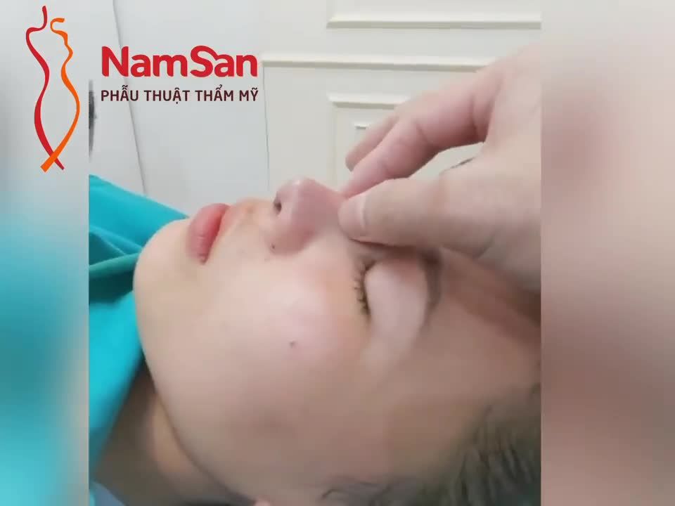 Sau mổ nâng mũi sụn tai, dáng cao tự nhiên