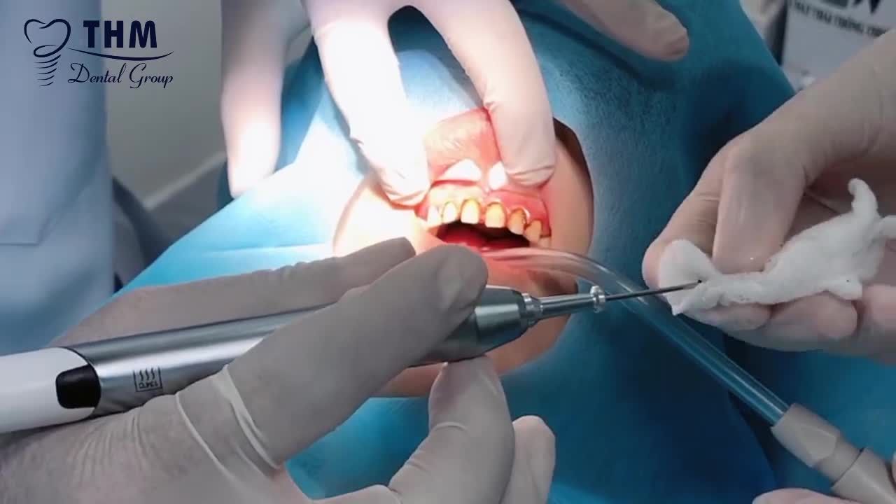 ƯU ĐIỂM TỪ PHƯƠNG PHÁP BỌC RĂNG SỨ TẠI NHA KHOA THẾ HỆ MỚI