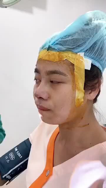 Khách hàng đầu mũi ngắn hếch, sóng mũi thấp, mô đầu mũi to