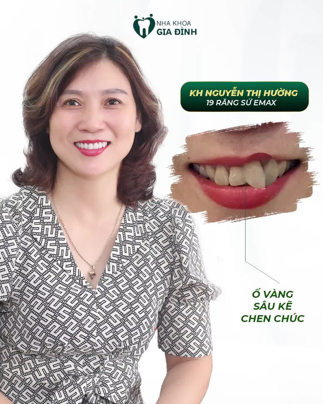THẨM MỸ RĂNG SỨ - PHỤC HÌNH HOÀN HẢO – CHỈ TỪ 2TR/RĂNG