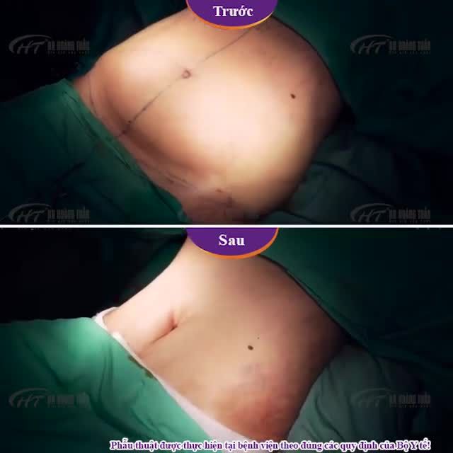 Nốt ruồi còn đó nhưng bụng mỡ thì đã không còn chỉ sau thời gian tạo hình thành bụng tại Dr Hoàng Tuấn.