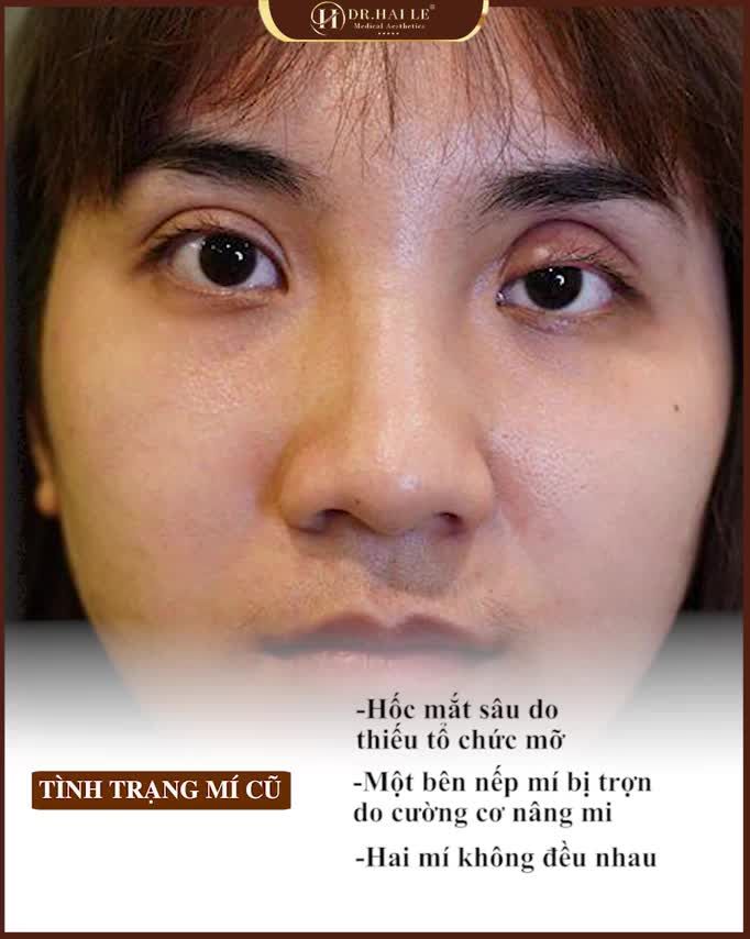 Từ hình ảnh đầu tiên khi gặp những biến chứng do cắt mí hỏng tại cơ sở thiếu uy tín đến Sưng bầm sau khi sửa mí Tới khi vào Form có nếp mí xinh đẹp.