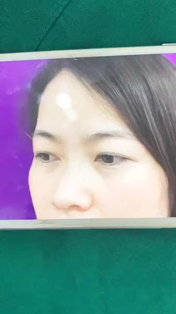 Ca mũi số 2 với dịch vụ nâng mũi Sline. Cả nhà cùng theo dõi và cho bác sĩ nhận xét nhé!