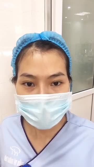 Khách hàng đã từng nâng mũi 2 lần ở spa nhưng mũi hiện tại thì như thế này đây ạ: