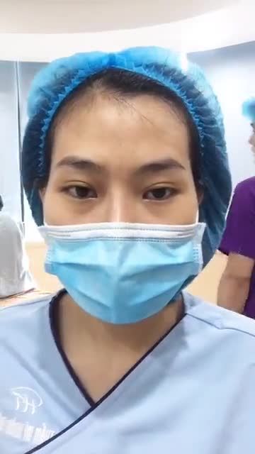 Kết quả nâng mũi Sline - ca mũi số 129 của bác sĩ đã có rồi đây, mời cả nhà cùng chiêm ngưỡng nhé