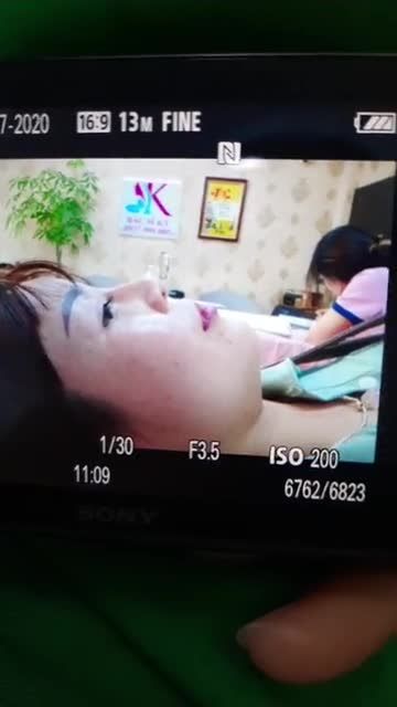 CA SỬA MŨI HỎNG , MỎNG DA, LỘ SỤN, ĐẦU MŨI HẾCH