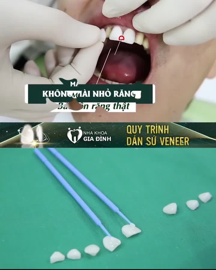 DÁN SỨ VENEER: RĂNG XINH CƯỜI ĐẸP – NHÌN LÀ MÊ LUÔN