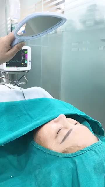 Nghỉ trưa thư giãn một chút bằng kết quả ca mũi số 4 của bác sĩ với dịch vụ nâng mũi Sline nhé!