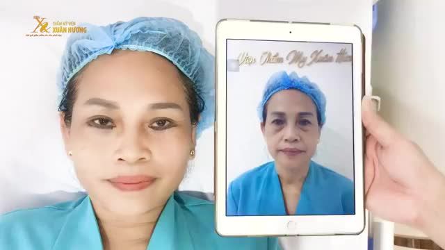 U60 TRẺ RA TỚI 10 TUỔI SAU CẮT MÍ DƯỚI TẠI TMV XUÂN HƯƠNG