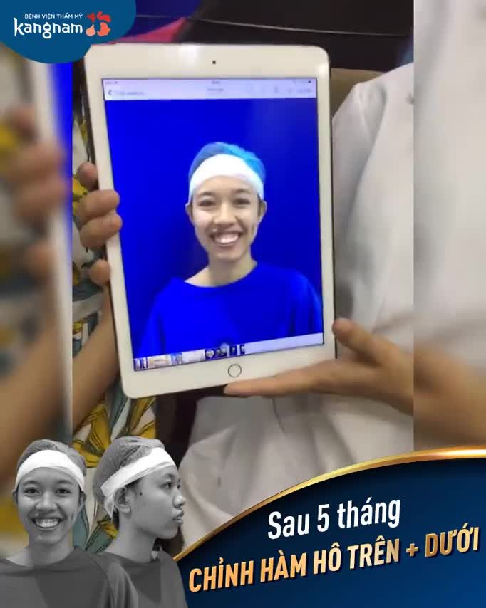 Quá khó để nhận ra khách hàng sau CHỈNH HÀM HÔ TRÊN DƯỚI