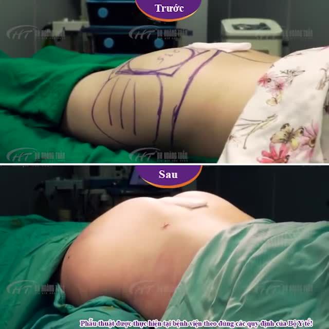 Trọn vẹn mọi góc so sánh sau nâng cấp V3 Dr Hoàng Tuấn