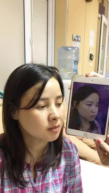 Vừa nhìn kết quả nâng mũi Sline của bác sĩ rồi, giờ mời cả nhà ngắm nhìn kết quả một ca nâng mũi cấu trúc Pureform nhé!