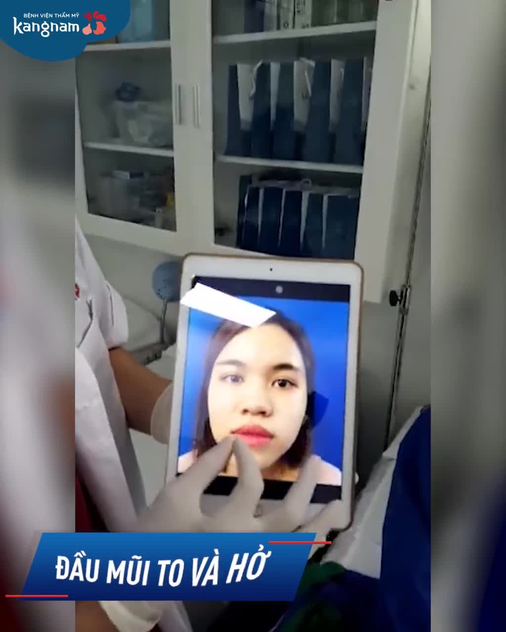 BẤT NGỜ trước kết quả COMBO Nâng mũi cấu trúc + Cắt cánh mũi