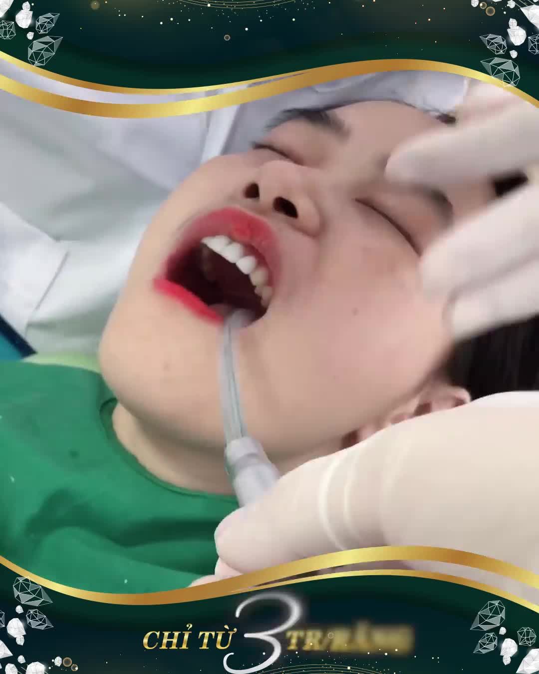 DÁN SỨ VENEER SIÊU MỎNG - KIẾN TẠO NỤ CƯỜI ĐẸP TỪNG MINIMET