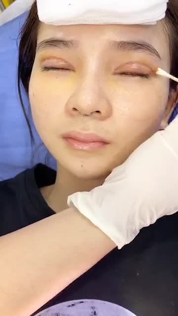 Cận cảnh quy trình CẮT CHỈ MÍ tại BVTM Kangnam