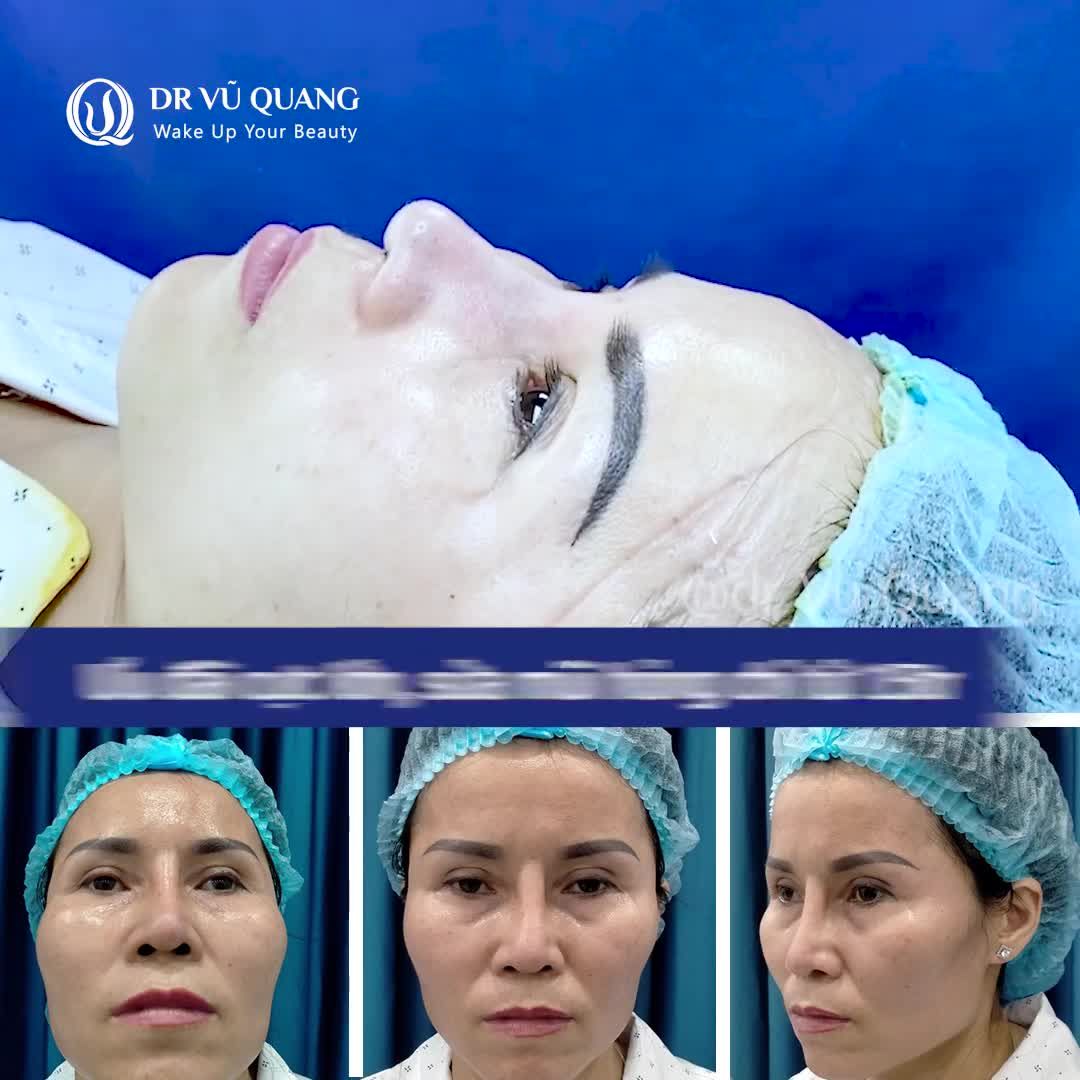SỬA MŨI LỆCH, LỘ SÓNG CHO CHỊ KHÁCH HÀNG ️.