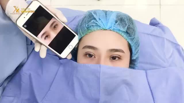 15 PHÚT NHẤN MÍ KHÔNG SƯNG KHÔNG ĐAU - KHÁCH HÀNG XINH ĐẸP VỚI MẮT 2 MÍ CÂN ĐỐI, ẤN TƯỢNG