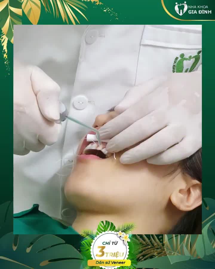 DÁN SỨ VENEER – PHƯƠNG PHÁP THẨM MỸ RĂNG “BẤT BẠI”