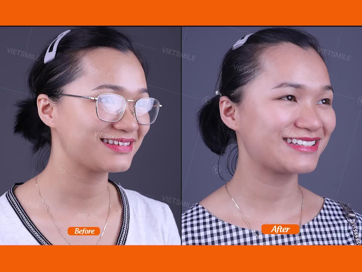 6 RĂNG SỨ EMAX PRESS - HÔ BIẾN KẼ THƯA RĂNG CỬA