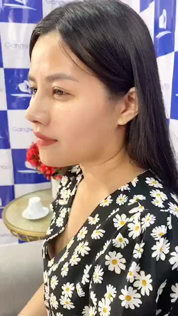 BẤT NGỜ VỚI KẾT QUẢ TÁI KHÁM SAU 2 TUẦN NÂNG MŨI NANO 3D TẠI GANGWHOO