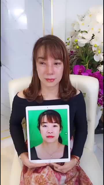 Chỉ mới 10 ngày mà Khách hàng tại Viện Thẩm Mỹ Saigon Venus đã sở hữu dáng mũi tuyệt vời, rất xinh đẹp .