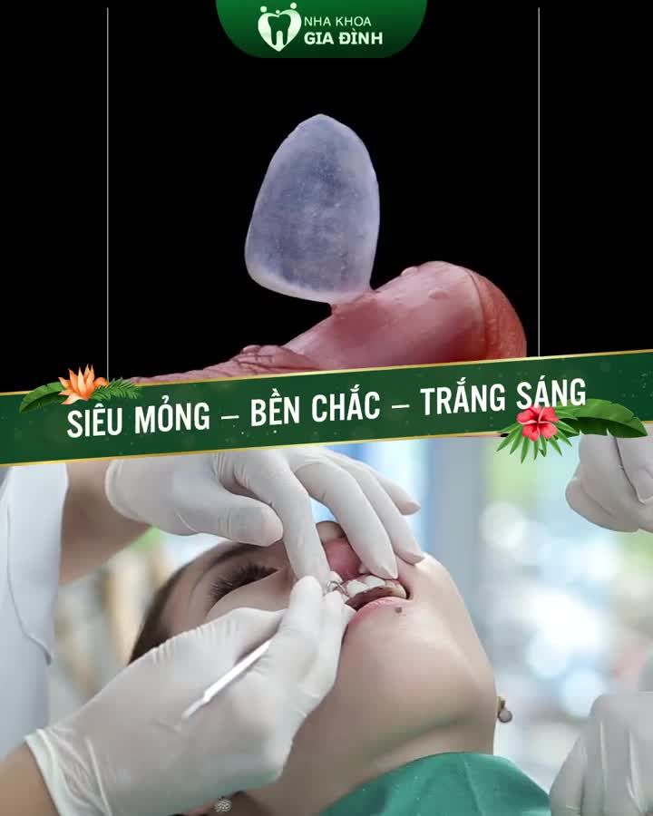 DÁN SỨ VENEER: SIÊU MỎNG – BỀN CHẮC – TRẮNG SÁNG