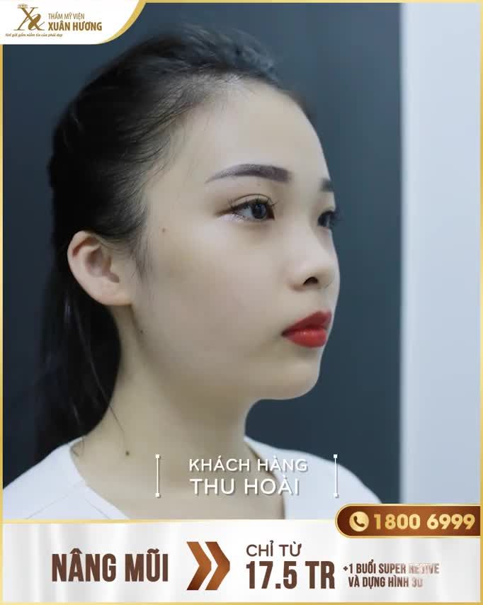DÁNG MŨI NHƯ Ý VỚI CHI PHÍ CỰC HỢP LÝ - NÂNG MŨI CHỈ TỪ 17,5 TRIỆU (giá gốc 25 triệu)