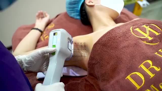 Đừng để hôi nách làm ngăn cách tình yêu! "Xóa sổ" viêm cánh với CN MiraDry - không đau- không phẫu thuật - không xâm lấn - Duy trì kết quả lâu dài.