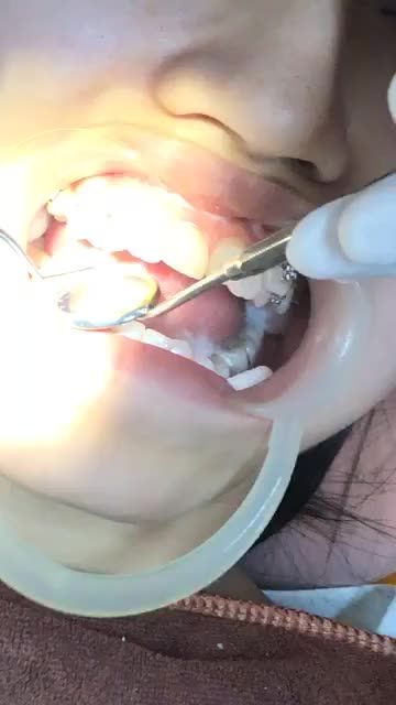 GẮN MẮC CÀI cho răng KHẤP KHỂNH tại Nha Khoa Vân Anh !!!