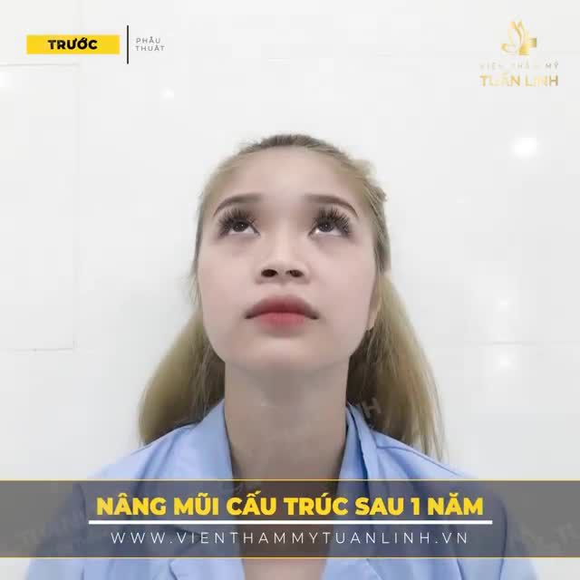 Khách hàng NÂNG MŨI CẤU TRÚC sau 1 năm tại VTM Tuấn Linh  Chỉ có thể nói là QUÁ ĐẸP.