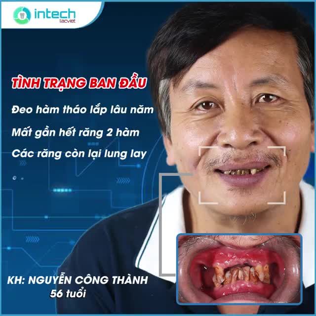 NGOÀI SỨC TƯỞNG TƯỢNG VỚI CÔNG NGHỆ CẤY RĂNG IMPLANT TẠI NHA KHOA LẠC VIỆT