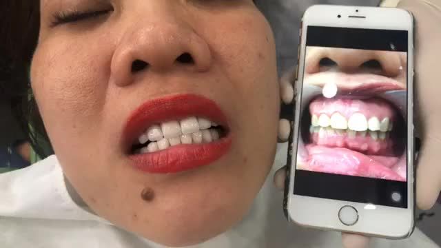 Răng công chức ntn có đẹp không bà con! P/s: 20 răng sứ thẩm mỹ Emax được hoàn thiện.