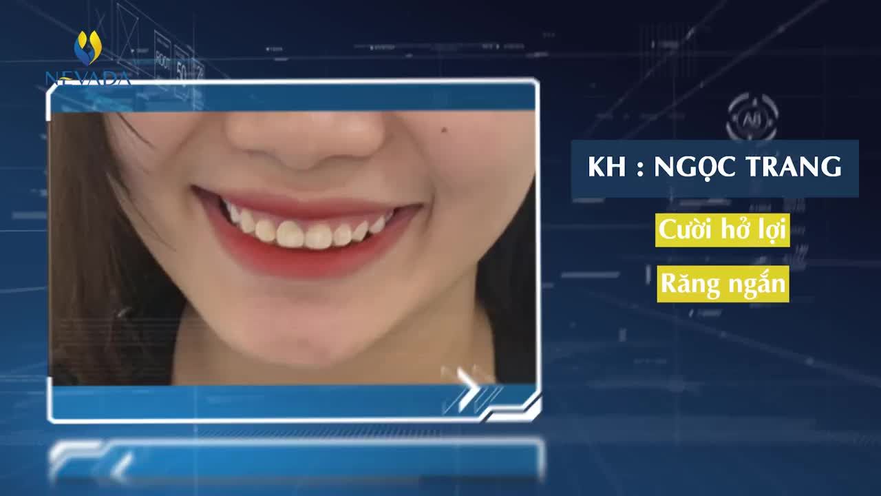 RĂNG NGẮN - CƯỜI HỞ LỢI: ĐÂU MỚI LÀ GIẢI PHÁP HOÀN HẢO??