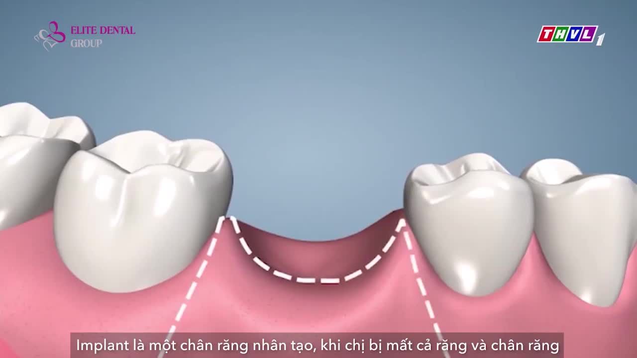 TRỒNG RĂNG IMPLANT - GIẢI PHÁP HOÀN HẢO KHI BỊ MẤT RĂNG