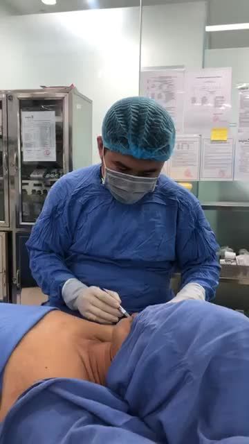 Chữa hôi nách TRIỆT ĐỂ bằng CN Endo Dry