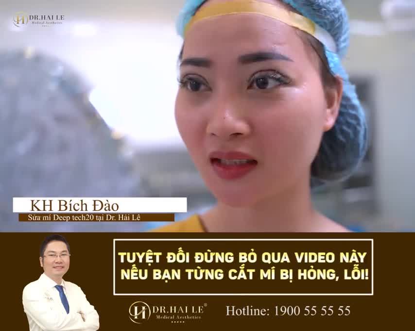 CẮT MÍ TẠI CƠ SỞ THIẾU UY TÍN SAU 1 NĂM KHIẾN nếp mí quá to, hai mí không đều, nếp mí quá to, cơ nâng mi yếu, sẹo xơ cứng, “mất ăn mất ngủ” vì lo lắng, tự ti.
