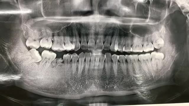 Cấy implant răng 46 cho anh Duy tại Nha Khoa Thuỳ Anh