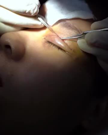 Mắt mí lót tuy nhiên lại ảnh hưởng đến thẩm mỹ, khiến khuôn mặt trở nên mệt mỏi, kém sắc, trông lờ đờ và thiếu sức sống…