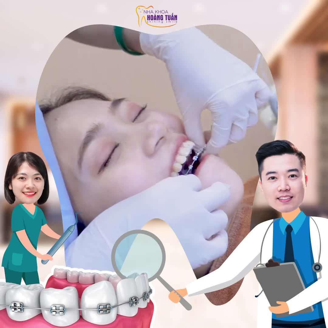 Xem thêm 35 video Niềng Răng của bác sĩ Dr Hoàng Tuấn