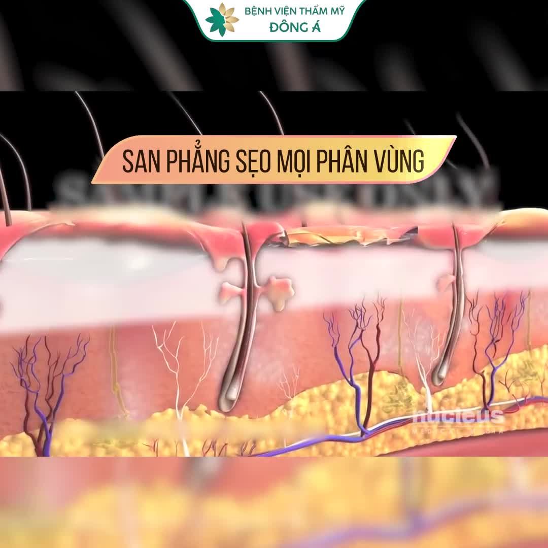 SẸO LỒI gây Ngứa? Mất thẩm mỹ? Khó chịu?