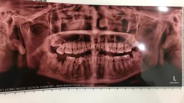 Cấy implant răng 47 cho bạn Phương tại Nha Khoa Thuỳ Anh.