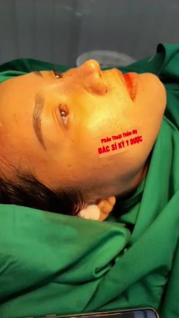 COMBO Nâng mũi bán cấu trúc sụn tai hai lớp Thu canh mũi Plasma