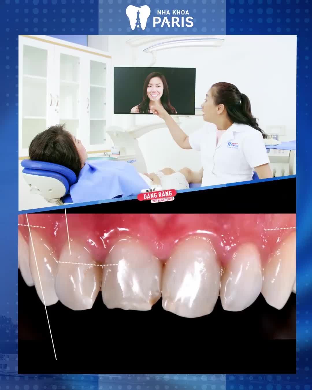 Răng Thưa /Hô /Khấp Khểnh /Nhiễm Màu