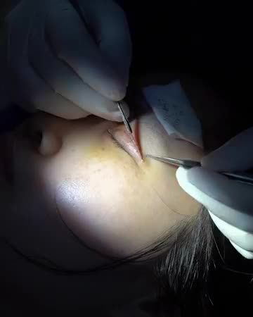 TAN CHẢY” VỚI SỰ THAY ĐỔI SAU CẮT CHỈ MÍ MẮT TẠI DR.HẢI LÊ