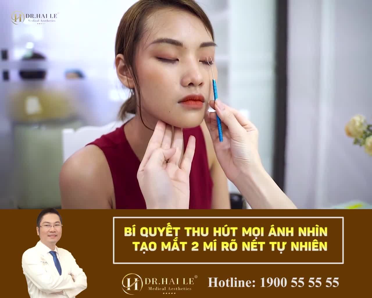 "Rũ bỏ" đôi mắt mí lót, mí nhỏ, 2 mí không đều; mí có nhiều nếp nhăn suốt nhiều năm!!!