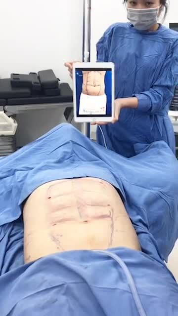 Kết quả biến bụng mỡ trở thành bụng 6 múi, săn chắc tại bệnh viện thẩm mỹ Kangnam