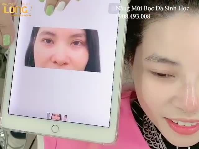 Buổi chiều với chiếc mũi đẹp xuất sắc cho 1 chị khách hàng hết sức dễ thương