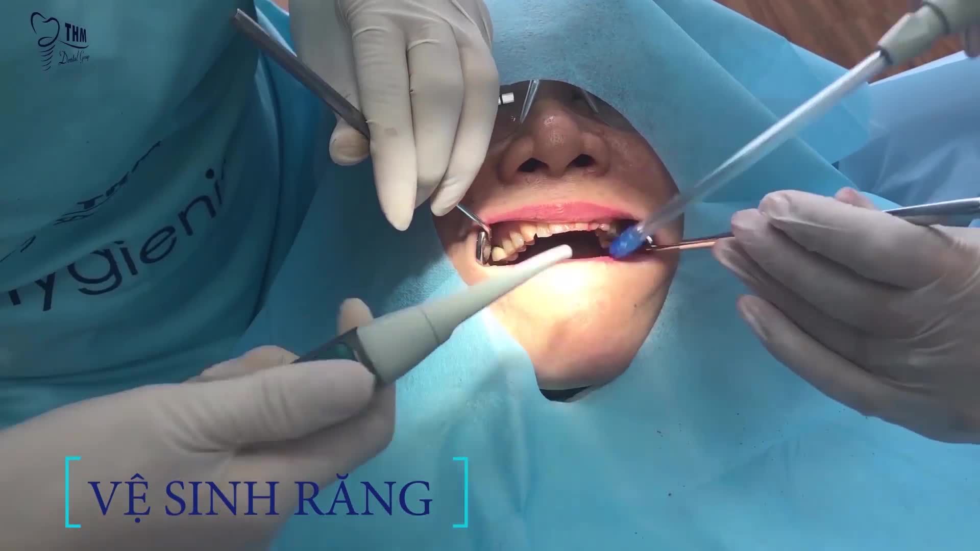 CƠ HỘI VỆ SINH RĂNG CHO MỌI NHÀ