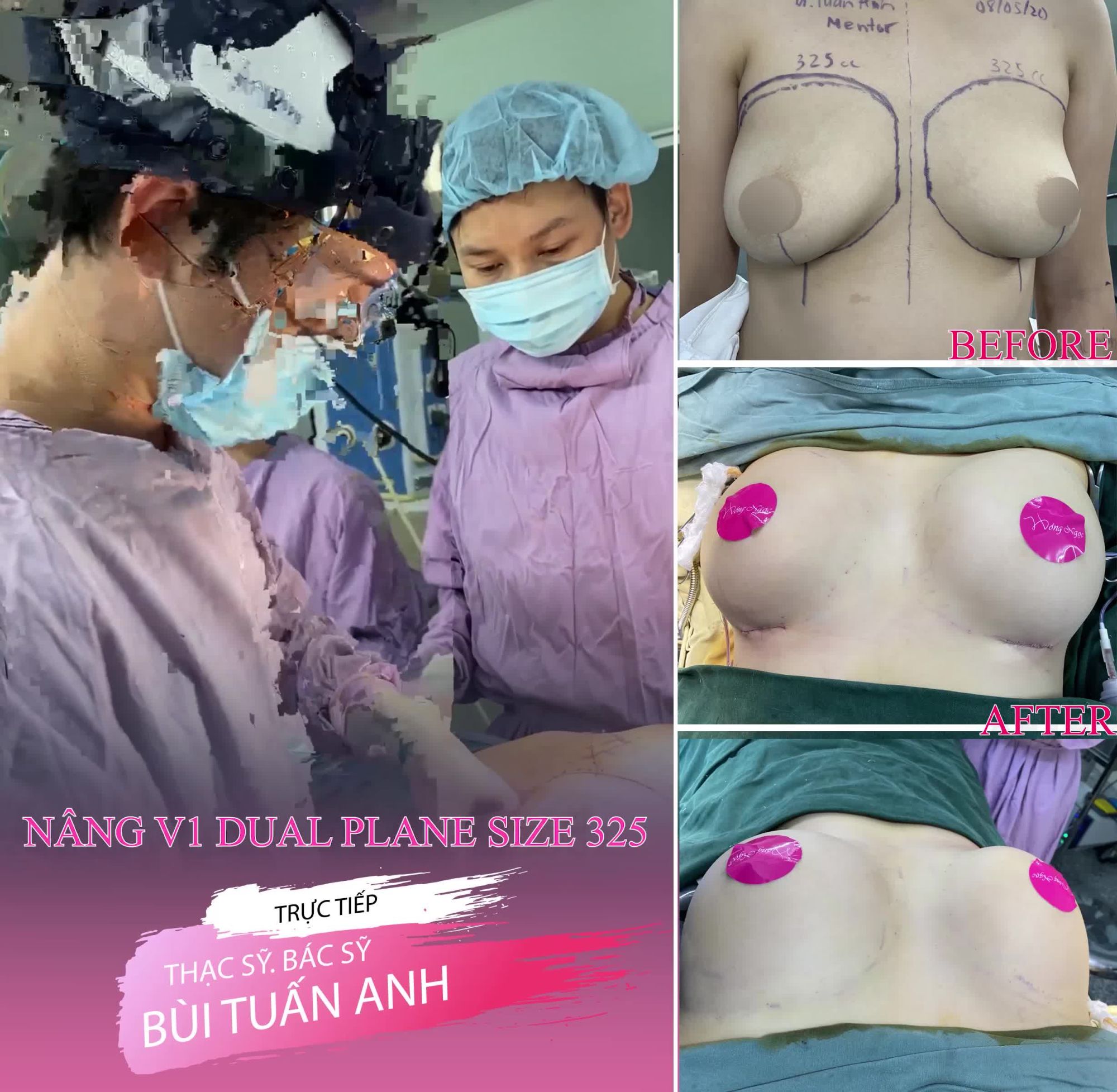 KHÓ MẤY BÁC SĨ VẪN LÀM! VÌ NÂNG V1 DUAL PLANE GIÚP CHỊ EM ĐẸP MỸ MÃN, ÍT SƯNG ĐAU