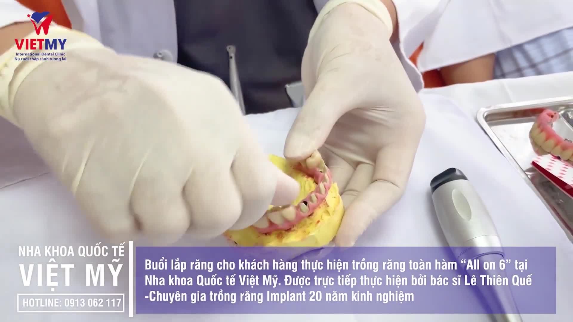 QUÁ TRÌNH PHỤC HÌNH RĂNG CHO NGƯỜI MẤT RĂNG TOÀN HÀM TẠI NHA KHOA QUÔC TẾ VIỆT MỸ